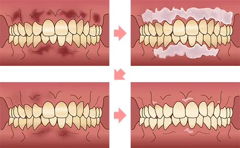 ピーリング手順イラスト